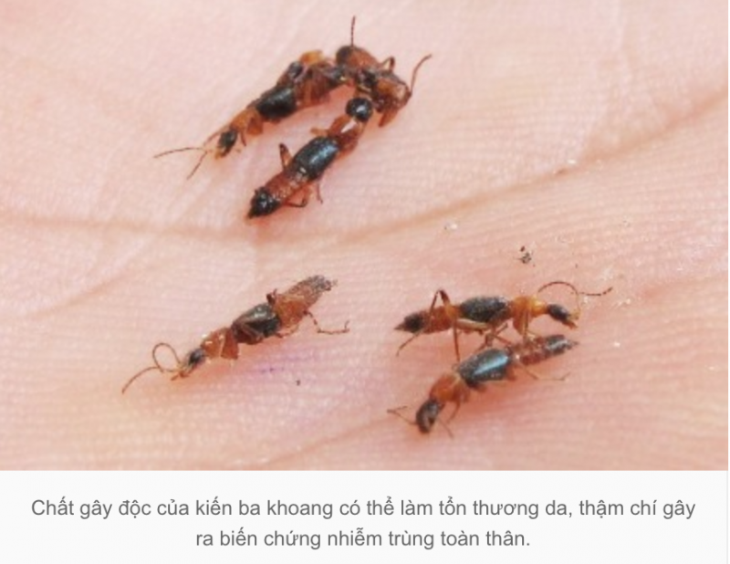 Số bệnh nhân viêm da do kiến ba khoang đốt tăng đột biến tại Hà Nội
