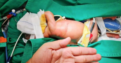 Bé gái sinh non nặng 1,7 kg, teo thực quản được cứu sống