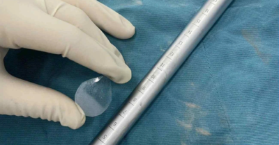 Dị vật ‘vô hình’ trong cổ họng bé trai: Lời cảnh tỉnh từ chiếc bánh sinh nhật