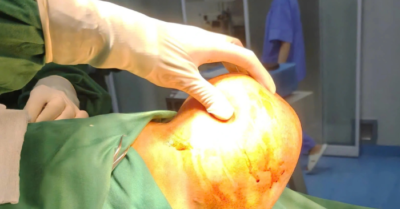 Người đàn ông “gánh” khối u khổng lồ trên vai suốt 5 năm